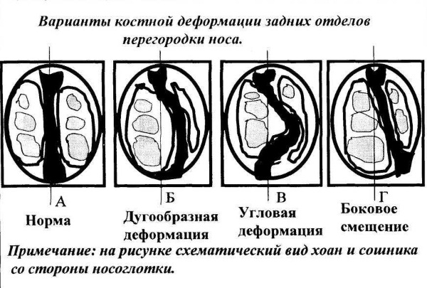 Пластическая операция на нос. Виды, цены: коррекция перегородки, уменьшение носа, убрать горбинку, изменить форму, контурная ринопластика