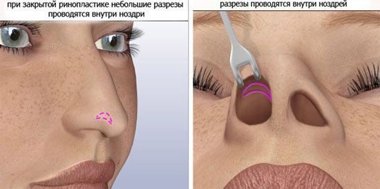 Пластическая операция на нос. Виды, цены: коррекция перегородки, уменьшение носа, убрать горбинку, изменить форму, контурная ринопластика